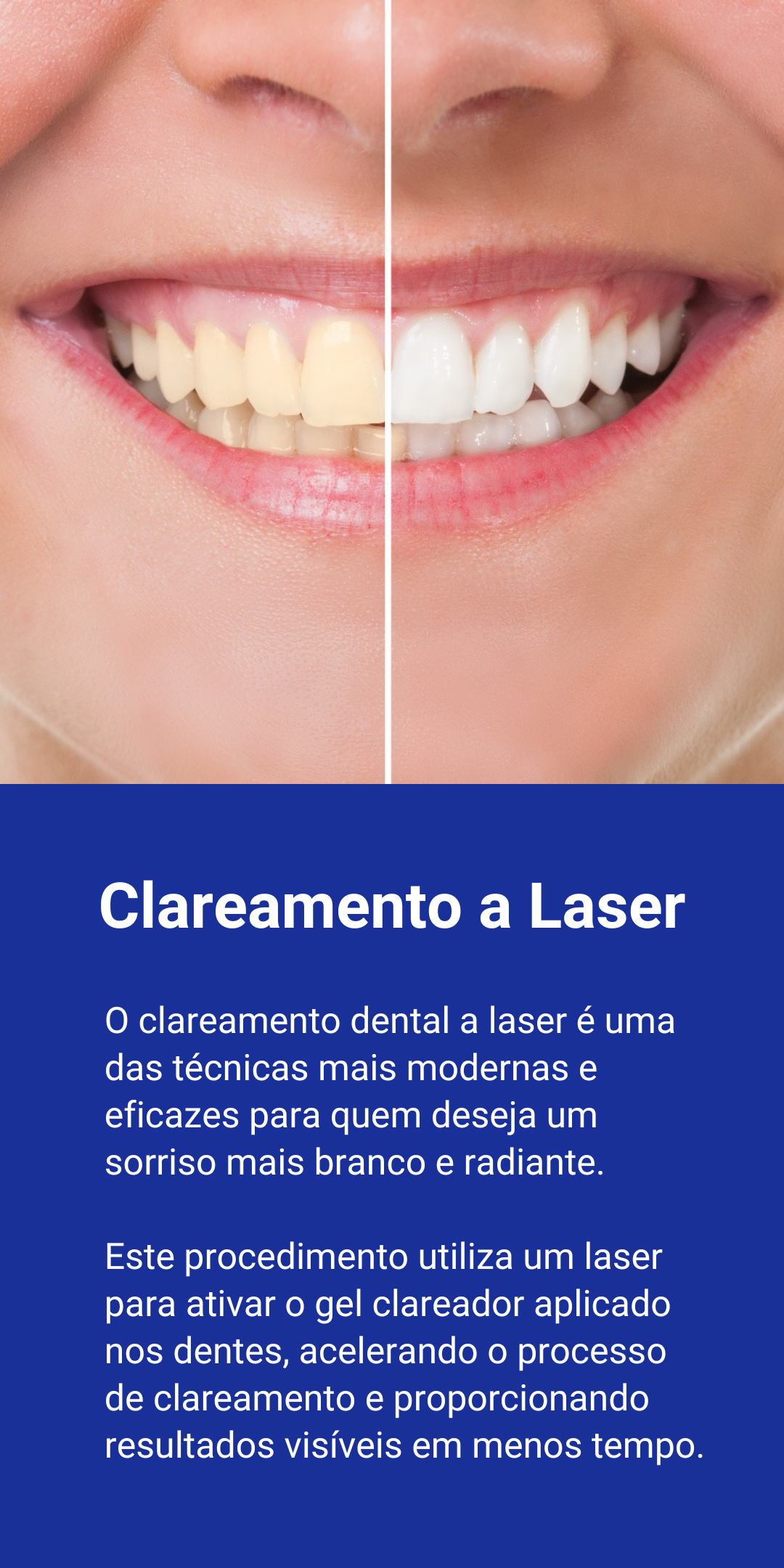 O clareamento dental a laser é uma das técnicas mais modernas e eficazes para quem deseja um sorriso mais branco e radiante. Este procedimento utiliza um laser para ativar o gel clareador aplicado